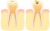 C1～2の虫歯