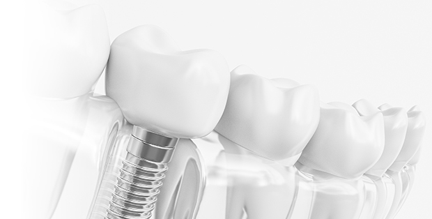 マイティスアローインプラントイメージ図